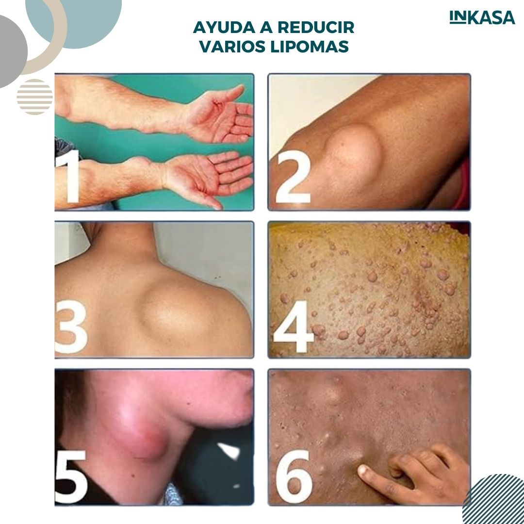 Spray Reductor de Lipomas