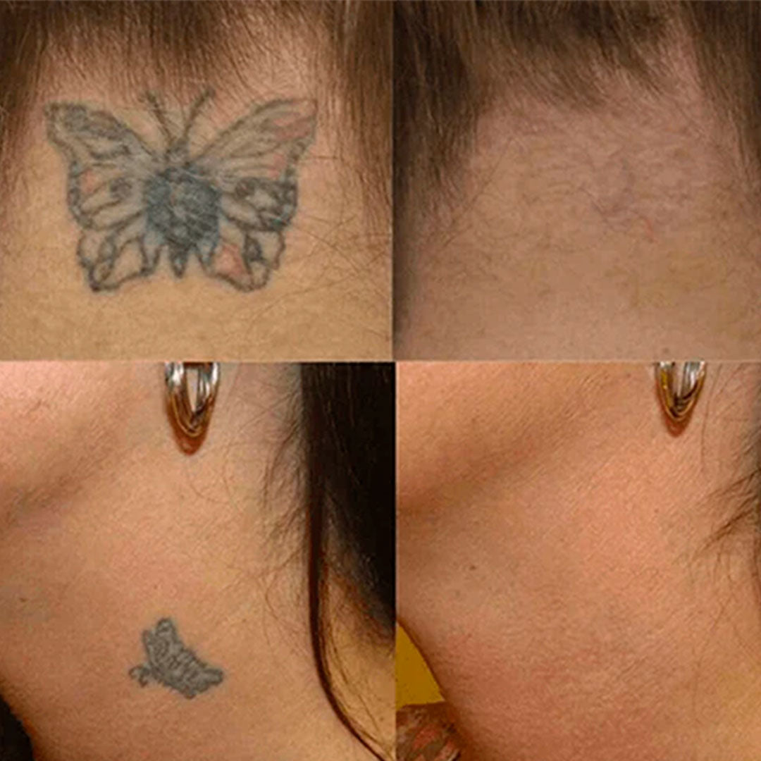🧴 Crema Eliminadora de Tatuajes – Desvanece Tinta sin Láser ni Cirugías