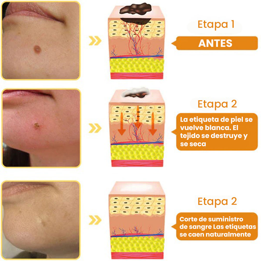 DermaClean PRO – Tratamiento Natural para Verrugas y Lunares🐝🧑⚕️