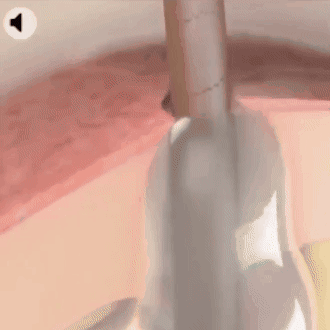 Spray Reductor de Lipomas