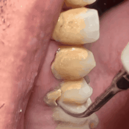 Kit limpiador oral removedor de sarro
