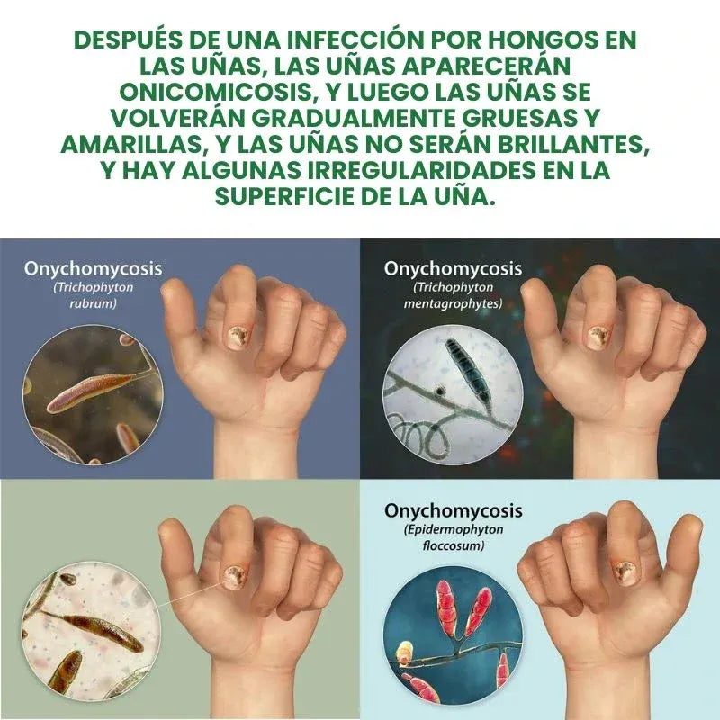 RETO 7 DÍAS LIBRE DE HONGOS EN UÑAS X2® Protege y elimina el hongo de tus uñas🦶🏻💅🏻