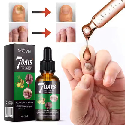 RETO 7 DÍAS LIBRE DE HONGOS EN UÑAS X2® Protege y elimina el hongo de tus uñas🦶🏻💅🏻