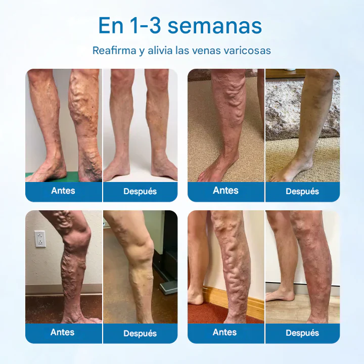 TRATAMIENTO PARA VENAS VARICOSAS ®Clínicamente probado para eliminar las venas varicosas en solo 7 días!
